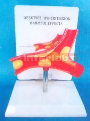 DESKTYPE (HYPERTENSION HARMFUL EFFECTS) DISEASE ARTERY WITH DESCRIPTION PLATE (ATYPE) 6.5 x 11.5 x 16.5 cm